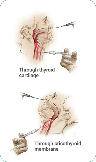 Injection through thyroid cartilage. Injection through cricothyroid membrane.