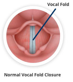 Normal vocal fold closure.