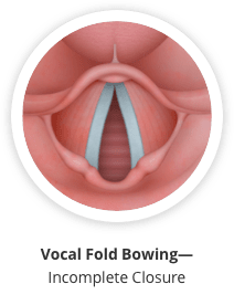Vocal fold bowing causes an incomplete closure.
