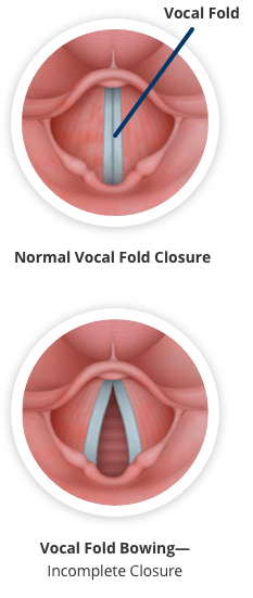 Normal vocal fold closure. Vocal fold bowing causes an incomplete closure.