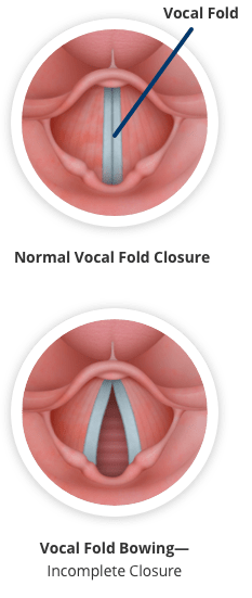 vocal cords damaged